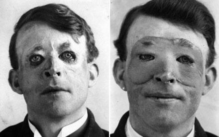 Walter Yeo first plastic surgery patient